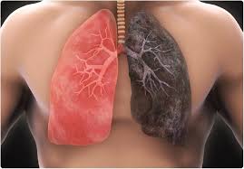 Descoperire medicală revoluționară: un nou tratament pentru cancerul pulmonar