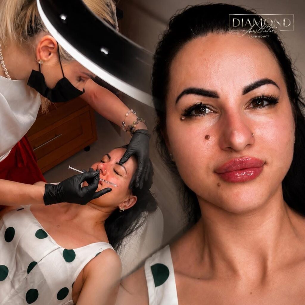 💋✨ Lip Filler & Botox – poza 3