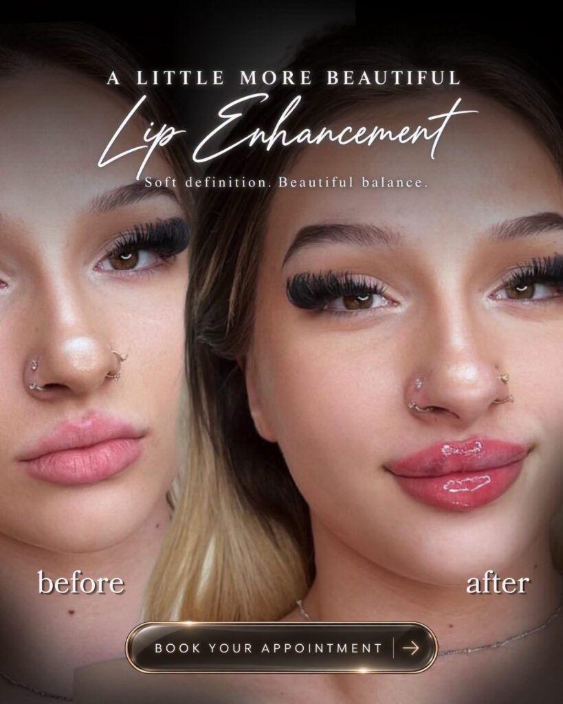 💋✨ Lip Filler & Botox – poza 4